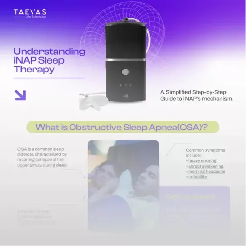 Understanding iNAP sleep therapy - A Simplified Step-by-Step Guide to iNAP’s mechanism